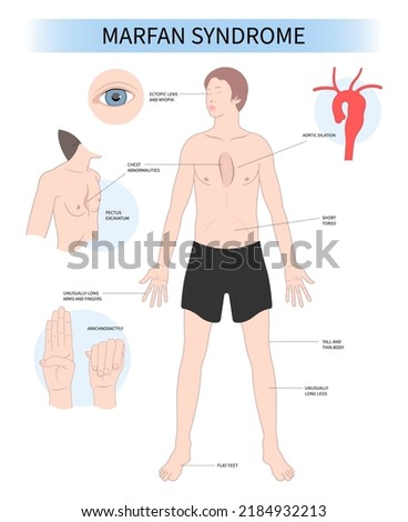 Marfan’s syndrome genetic condition disease Enlarged Heart syndrome malformation Gene Mutation Imagine de stoc © 