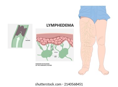 Meige’s Syndrome Milroy Leg Edema Venous Deep Vein Cancer Swelling Upper Limb Wrap Calf Ulcer Meige Lymph Node Arms Hand Pain Cloth Blood Feet Ankle Liver Kidney Heart Lung Non Nonpitting Pedal