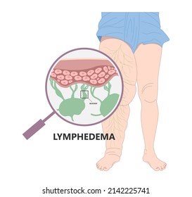 Meige’s Syndrome Milroy Leg Edema Venous Deep Vein Cancer Swelling Upper Limb Wrap Calf Ulcer Meige Lymph Node Arms Hand Pain Cloth Blood Feet Ankle Liver Kidney Heart Lung Non Nonpitting Pedal