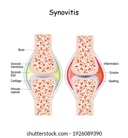 synovitis. Close-up. comparison and difference between a healthy joint and a joint with inflammation of the synovial membrane. Signs and symptoms of the disease