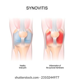 Synovitis. Human Knee joint anatomy. Healthy joint, and Inflammation of the synovial membrane. front view. anterior aspects. Vector illustration