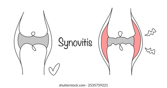 Synovitis. An inflammatory disease that affects the synovium. A healthy joint and a joint with inflammation and accumulation of effusion. Isolated vector.