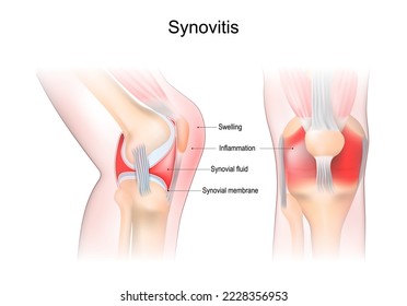 sinovitis de una rodilla. Cierre de la articulación con inflamación de la membrana sinovial. Signos y síntomas de la enfermedad. Anatomía de las articulaciones sinoviales. Vista frontal y lateral de la articulación de la rodilla humana. Vector