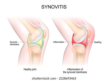 synovitis of a Knee. Close-up of normal joint, and knee with inflammation of the synovial membrane. Signs and symptoms of the disease. side view of human knee joint. Vector illustration