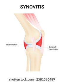 Synovitis (Synovial Inflammation) Symptoms and Causes