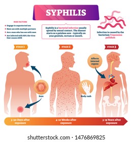 Syphilis vector illustration. Labeled sexual infection explanation scheme. Anatomical infographic with exposure stages, symptoms and risk factors. Unprotected contact disease and transmission illness.