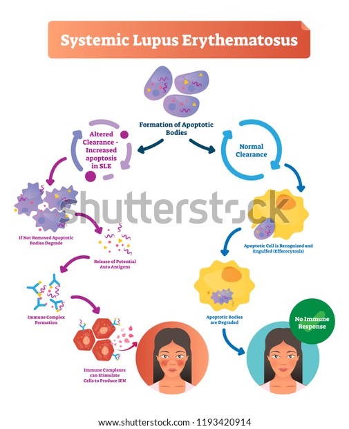 Systemic lupus erythematosus\
labeled diagram with normal and sick patient. Scheme of apoptotic\
bodies formation, altered clearance, bodies degradation and\
stimulation.