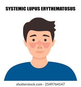 Lúpus eritematoso sistêmico. Homem com a típica erupção cutânea de borboleta no lúpus. LES. doença da pele