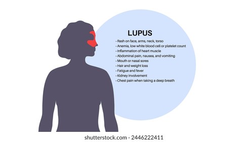 Systemic lupus erythematosus medical poster. Butterfly or malar rash on a female face. Autoimmune disease concept. Inflammation and skin tissue damage, pain in the internal organs vector illustration