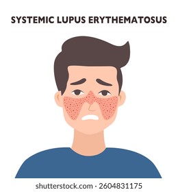 systemic lupus erythematosus. Young man with the typical butterfly rash in lupus. SLE. skin disease