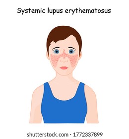 Systemic Lupus Erythematosus. Young Woman With The Typical Butterfly Rash In Lupus. SLE. Skin Disease