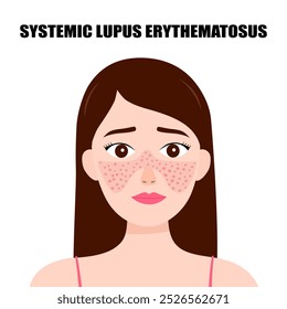 Systemic lupus erythematosus. Young woman with the typical butterfly rash in lupus. SLE. skin disease