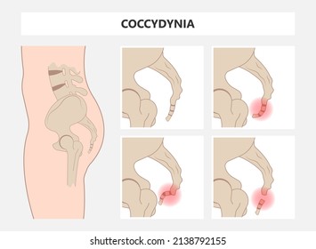 Fases de fractura de hueso de cadera y lesión