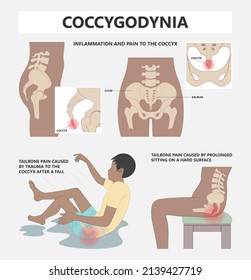 Tail bone pain floor hip spine sitting down back leg fall slip broken poor chair lower trauma tumor symptom joint surgery coccalgia good work from home computer ergonomic seating sacroiliitis