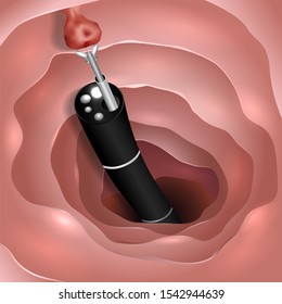 Taking Tissue From Cancer Cell By Colonoscopy