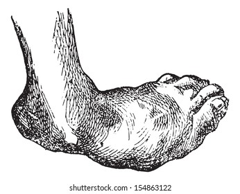 Talipes valgus, vintage engraved illustration. Usual Medicine Dictionary - Paul Labarthe - 1885.