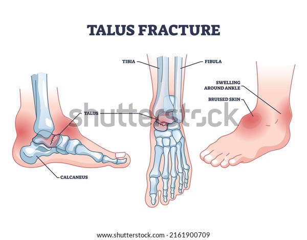 Talus fracture as broken leg with swelling ankle
symptom outline diagram. Labeled educational scheme with medical
bone trauma vector illustration. Human leg foot anatomical
structure with painful
part