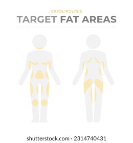 Target fat areas for Cryolipolysis.
Vector infographic medical of pictograms of the human body with fat deposit and treatment areas for fat freezing.
Anatomical location of localized fat mass. Poster