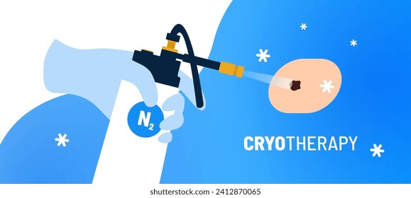 Targeted cryotherapy procedure for mole on skin. Medical instrument with liquid nitrogen in doctors hand. Cryogenic precision for improved health and well-being. Minimally invasive therapy