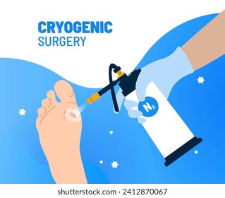 Targeted cryotherapy procedure for mole on foot. Medical instrument with liquid nitrogen freezing a tumor on a sole. Painless cryogenic surgery for skin treatments. 