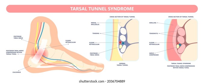Tarsal tunnel syndrome flat feet flatfoot tibial tear running ankle bone tendon nerves pain foot compresses fallen arches vein cyst swollen spur carpal heel injury trauma torn inflamed adult