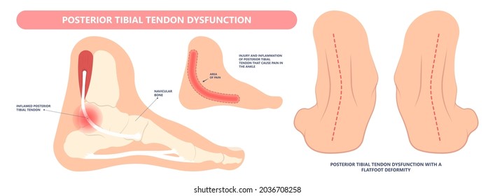 Tarsal tunnel syndrome flat feet flatfoot tibial tear running ankle bone tendon nerves pain foot compresses fallen arches vein cyst swollen spur carpal heel injury trauma torn inflamed adult