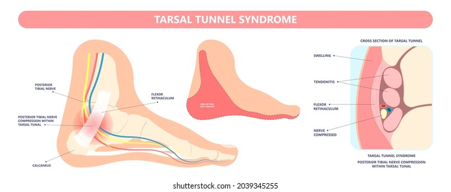 Tarsal tunnel syndrome flat feet flatfoot tibial tear running ankle bone tendon nerves pain foot compresses fallen arches vein cyst swollen spur carpal heel injury trauma torn inflamed adult