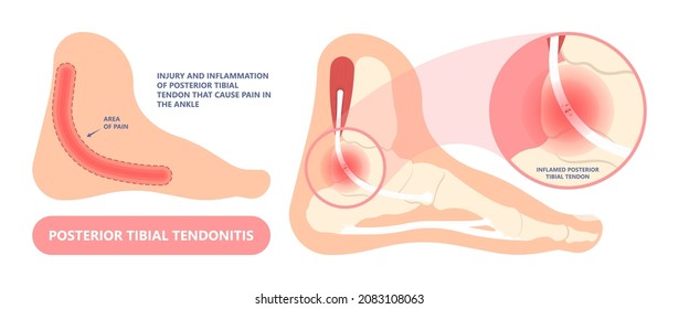 Tarsal tunnel syndrome flat feet flatfoot tibial tear running ankle bone tendon nerves pain foot compresses fallen arches vein cyst swollen spur carpal heel injury trauma torn inflamed adult