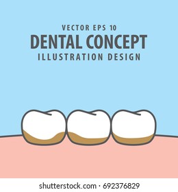 Tartar or calculus teeth illustration vector on blue background. Dental concept.