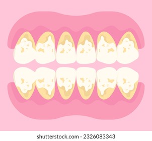 tartar grinding pain syndrome Before and after of dental scaling for toothache in dentistry with abfraction disease the teeth fracture crack broken with Bad breath