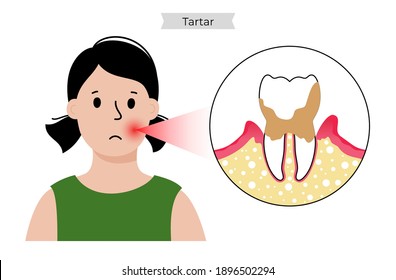 Tartar, Plaque, Toothache Disease. Child In Dental Clinic. Dentist, Stomatology, Tooth Anatomy Poster Flat Vector Illustration. Oral Hygiene Medical Banner. Medicine, Pills, Diagnosis And Treatment.