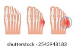 Taylor deformation. Valgus deformity of the little toe joint. Vector illustration.