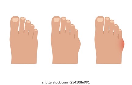 Taylor deformation. Valgus deformity of the little toe joint. Vector illustration.