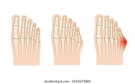 Taylor deformation. Valgus deformity of the little toe joint. Vector illustration.