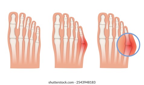 Taylor deformation. Valgus deformity of the little toe joint. Vector illustration.