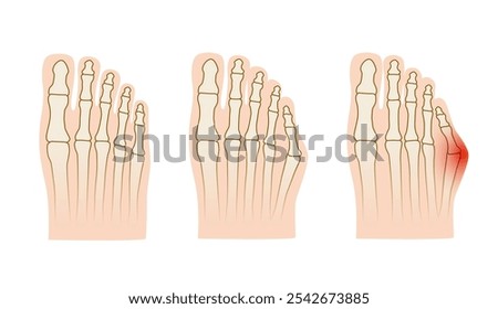 Taylor deformation. Valgus deformity of the little toe joint. Vector illustration.