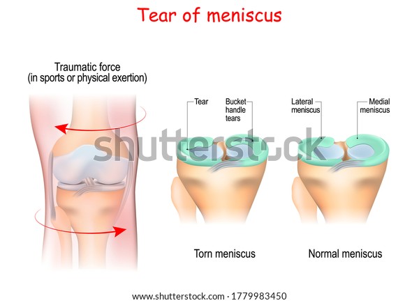 tear of a meniscus is a\
rupturing of one or more of the fibrocartilage strips in the knee.\
Human Joint, and Traumatic force in sports or physical exertion.\
Torn meniscus.