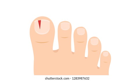 Tear nails cartoon vector. free space for text. wallpaper. copy space. foot thumb vector.