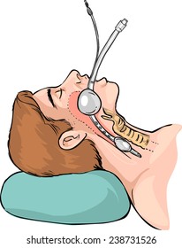 Technique of tubal intubation