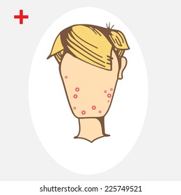 Teenage boy with a pimple on her cheek. Acne . Acne of a 14-year-old during puberty. Rubella. Rash on face and body. Eps 8