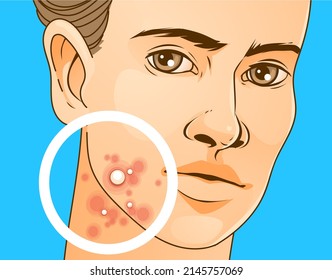 A teenage kid with skin problems.  Pimple problems. Healthcare illustration, medical infographic. Vector illustration.