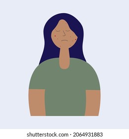 Teenager girl upset with her face acnes, pimples. Acne prone skin problems and dermatology.  Young woman with acne, eczema, psoriasis. 