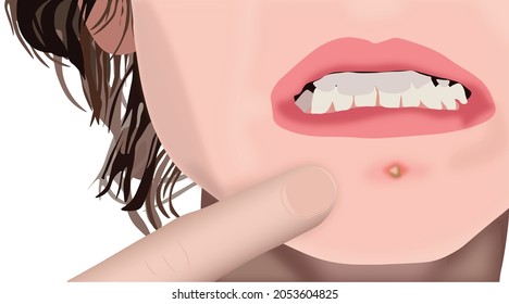 teenagers with a pimple on her chin. Awkward and embarrasing moment of face person with acne