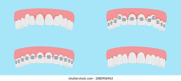 Teeth alignment concept with braces. A poster with crooked teeth, braces and even healthy ones. Simple teeth in a row. Orthodontic treatment. Isolated vector illustrations. Flat style.