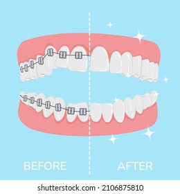 Teeth alignment concept with braces. A poster with crooked teeth, braces and even healthy ones. Simple teeth in a row. Orthodontic treatment. Isolated vector illustrations. Flat style.
