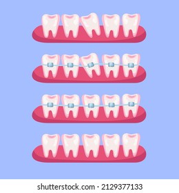 Teeth before and after braces cartoon illustration set. Stages of dental alignment or treatment with usage of brackets for beautiful smile. Orthodontist, healthcare, medicine concept