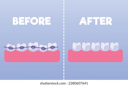 Teeth before and after braces flat style, vector illustration isolated on blue background. Alignment of bite of teeth, dentition with braces, comparison, orthodontic treatment