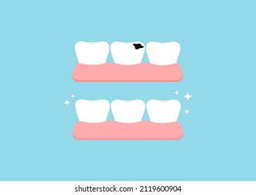 Teeth before and after decay in gym dental icon set isolated on blue background. Tooth with dental caries hole treatment concept. Flat cartoon dentistry clip art vector illustration. 
