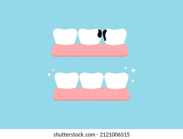 Teeth before and after proximal decay in gym dental icon set isolated on blue background. Both tooth with interdental caries hole treatment concept. Flat cartoon dentistry clip art vector illustration