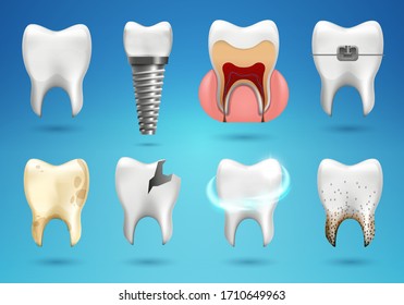 Teeth big set in 3d realistic style. Realistic healthy tooth, dental implant, caries, brocken , calculus, braces.